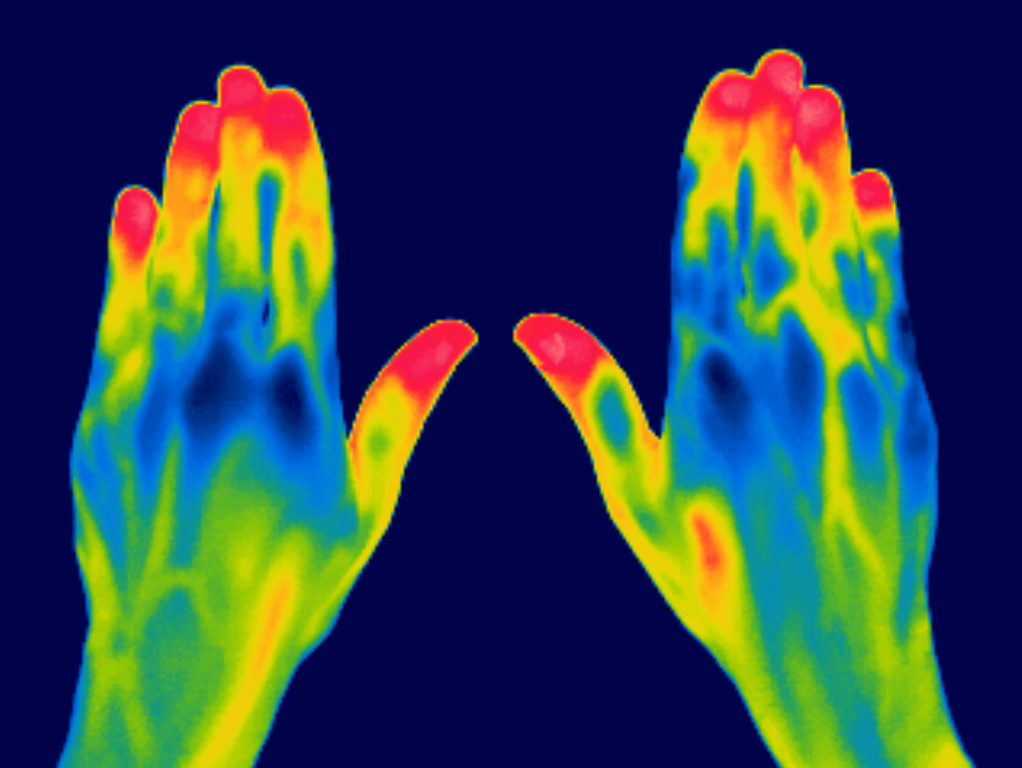 Thermographic image of hands